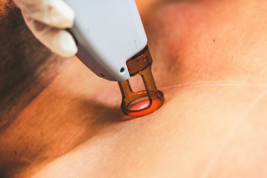 Eliminación de tatuajes con láser